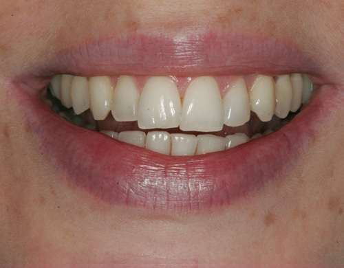 Before Image: Dental Bonding Contouring - front