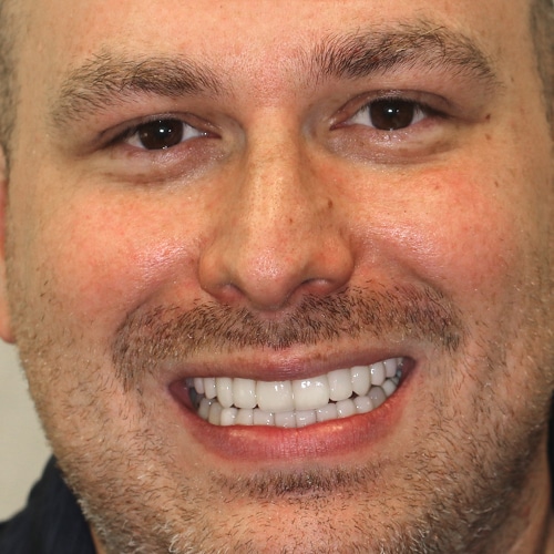 After Image: Dental Veneer - front