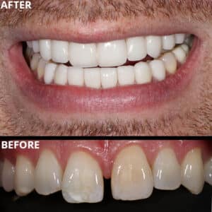 Before Image: Dental Veneer