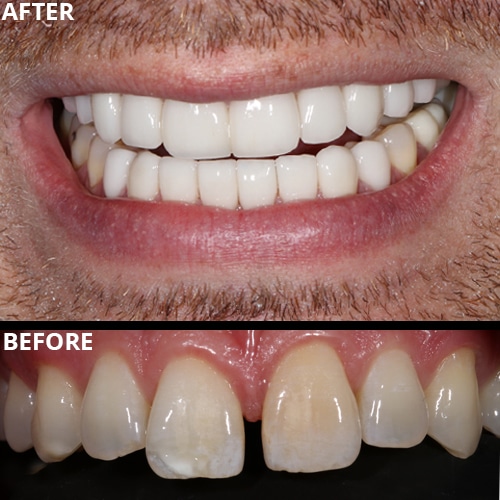 Before Image: Dental Veneer - front