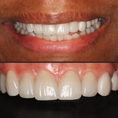 After Image: Tooth Gap Closure - front