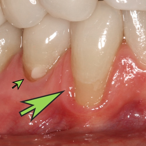 Before Image: Gum Graft - front