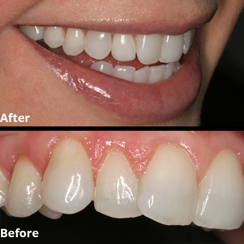 Before Image: Porcelain Veneer - front