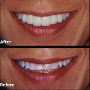 Before Image: Dental Veneer Makeover