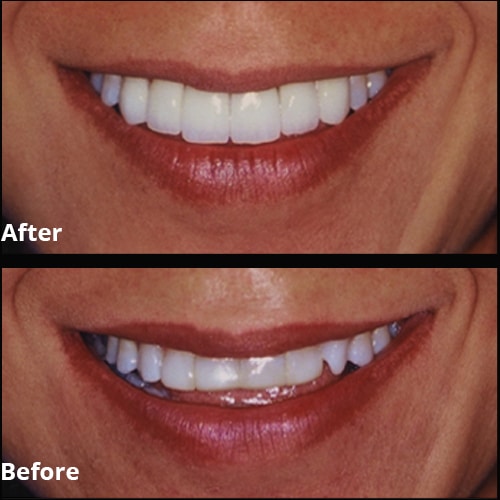 Before Image: Dental Veneer Makeover - front