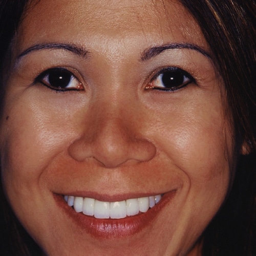 After Image: Dental Veneer Makeover - front