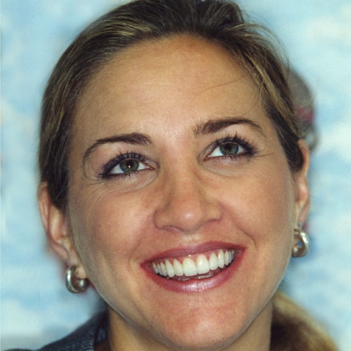 After Image: Cosmetic Veneers - front