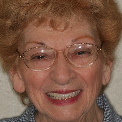 After Image: Cosmetic Dentures - front