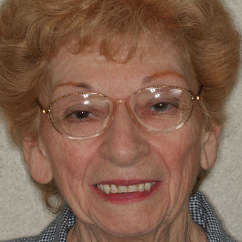 Before Image: Cosmetic Dentures - front