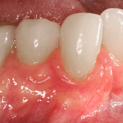 After Image: Gum Graft - front