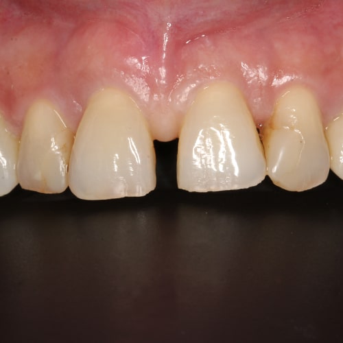 Before Image: Tooth Gap Closure - front