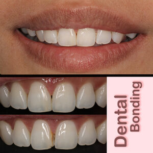 cosmetict dental bonding