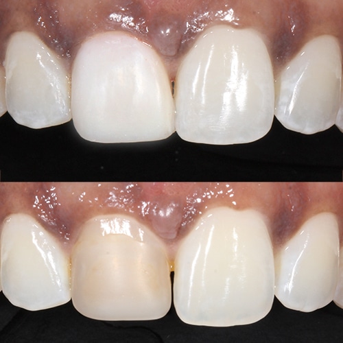 Before Image: Single Tooth Composite Bonding - front