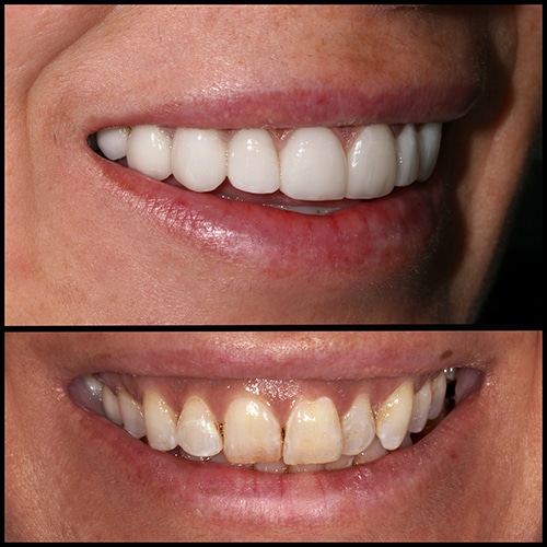 After Image: Cosmetic Dental Veneers - front