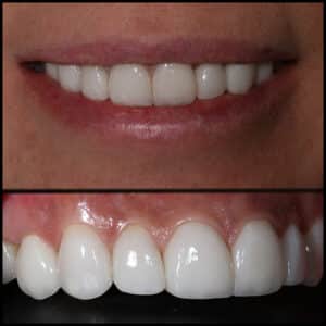 After Image: Cosmetic Dental Veneers