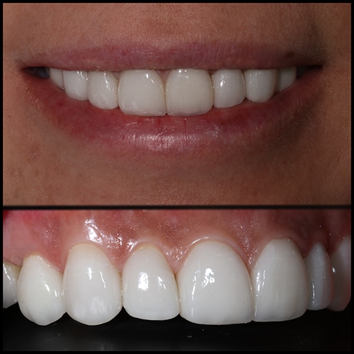 After Image: Cosmetic Dental Veneers - front