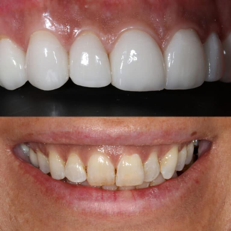 After Image: Cosmetic Dental Veneers - front