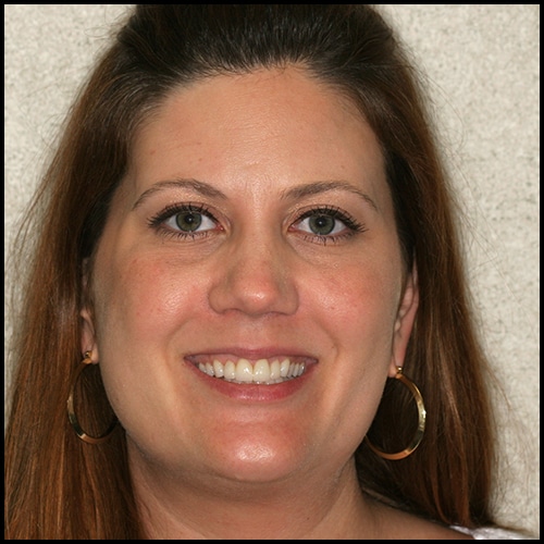 After Image: Cosmetic Dental Veneers - front