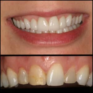 Before Image: Esthetic Dental Veneers