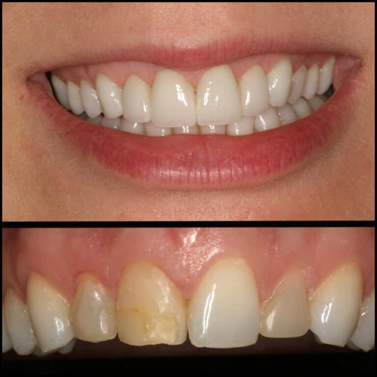 Before Image: Esthetic Dental Veneers - front
