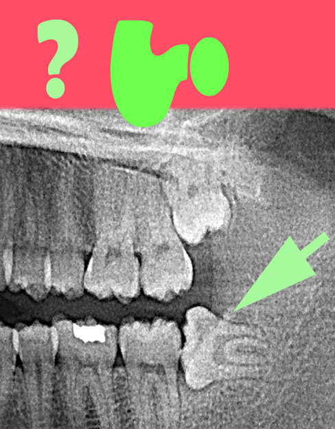 molar dental xray