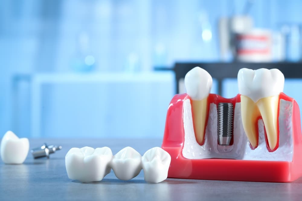 Dental model of teeth with a tooth missing and a dental bridge next to it for repair.