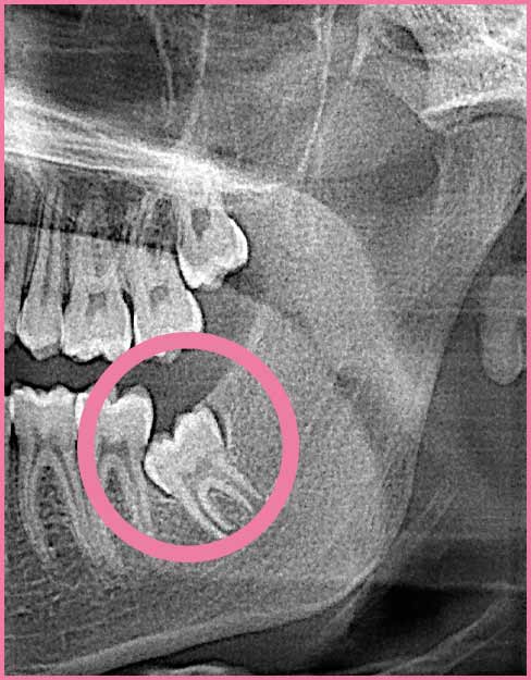 third molar xray