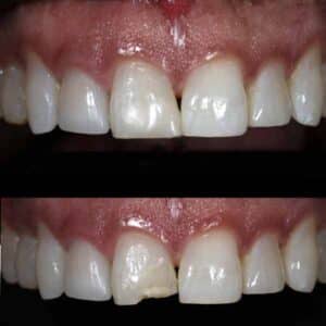 Before Image: Front Tooth Composite Bonding