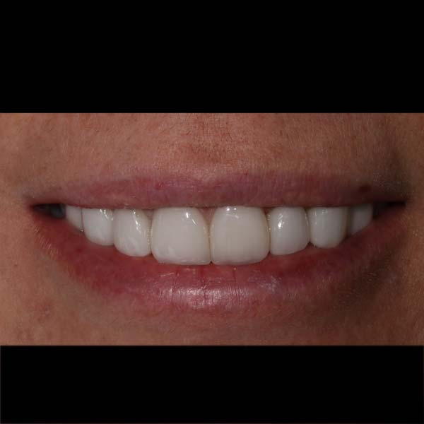 After Image: Cosmetic Dental Veneers - front
