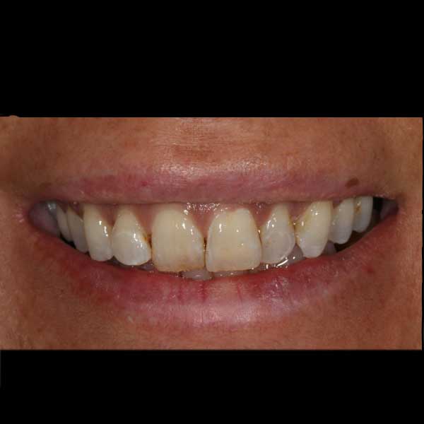 Before Image: Cosmetic Dental Veneers - front