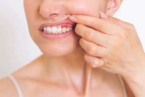 Close up of a woman showing her enflamed and irritated gums as a result of gum disease.