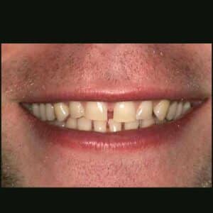 Before Image: Cosmetic Dental Veneer Results