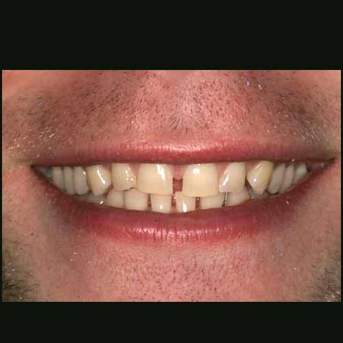 Before Image: Cosmetic Dental Veneer Results - front
