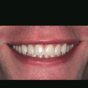 After Image: Cosmetic Dental Veneer Results