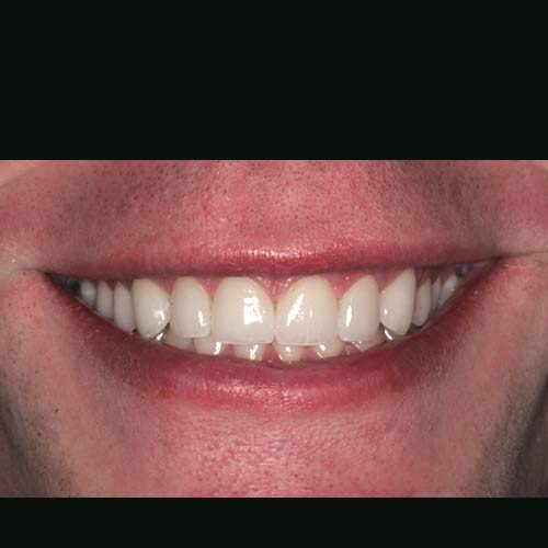 After Image: Cosmetic Dental Veneer Results - front