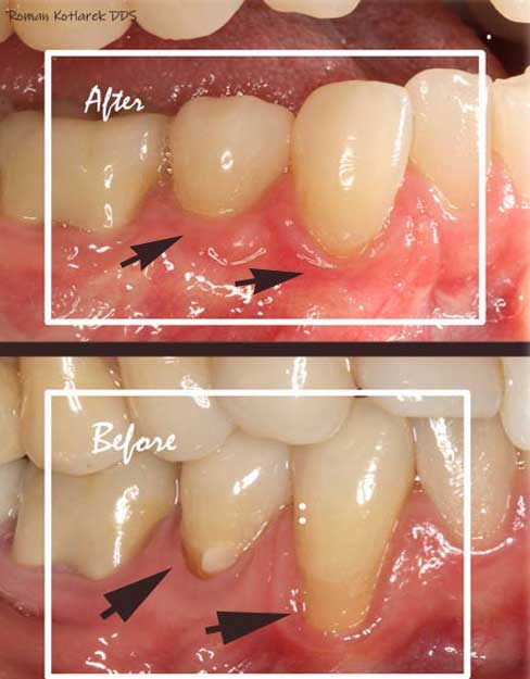 Gum graft image