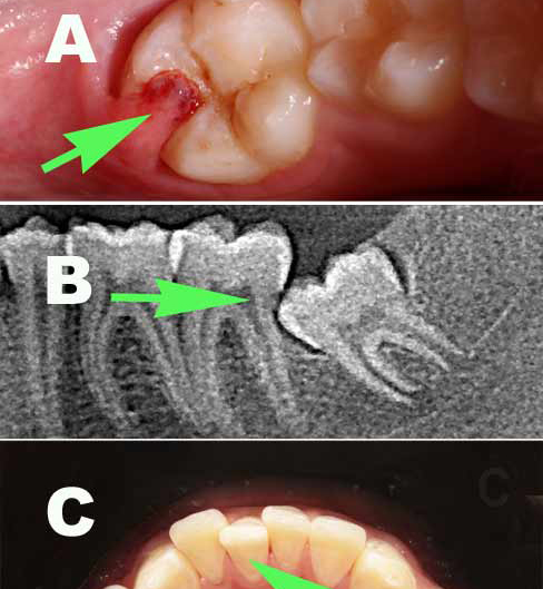 impaction problems