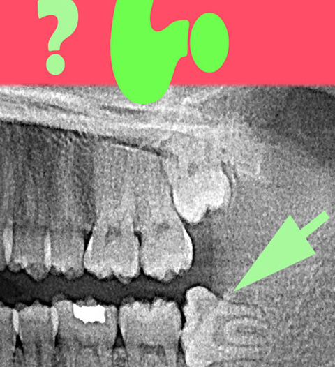 molar dental xray