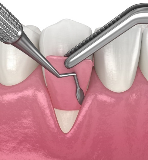 periodontal 6