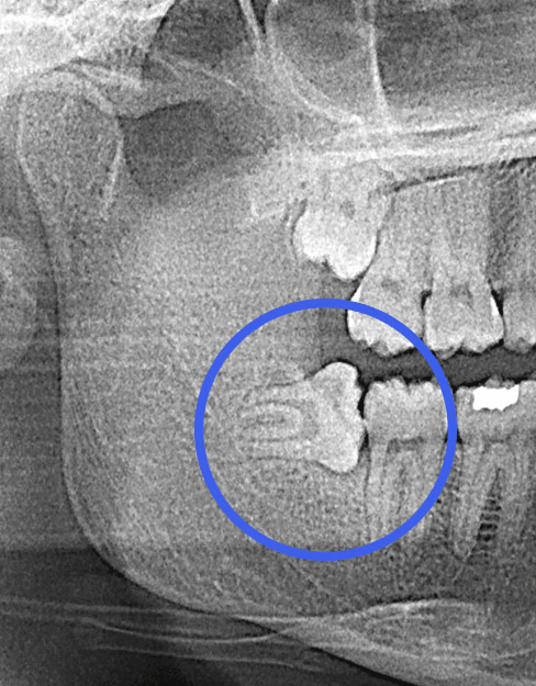 wisdom tooth xray
