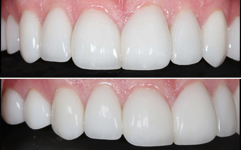 ba-veneers-after