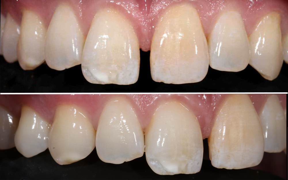 ba-veneers-before ba-veneers-before