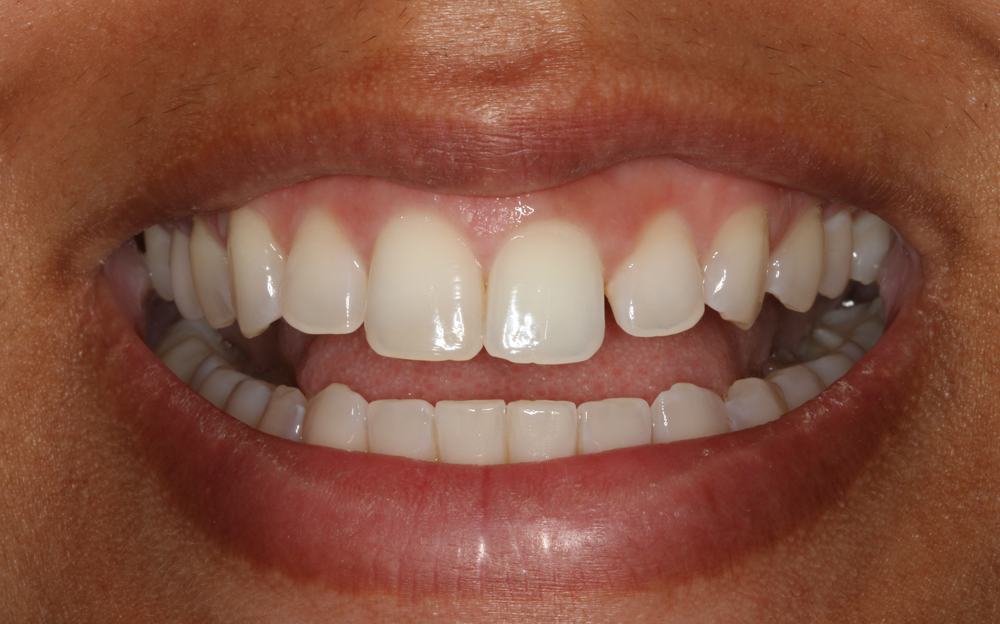 ba-whitening-after
