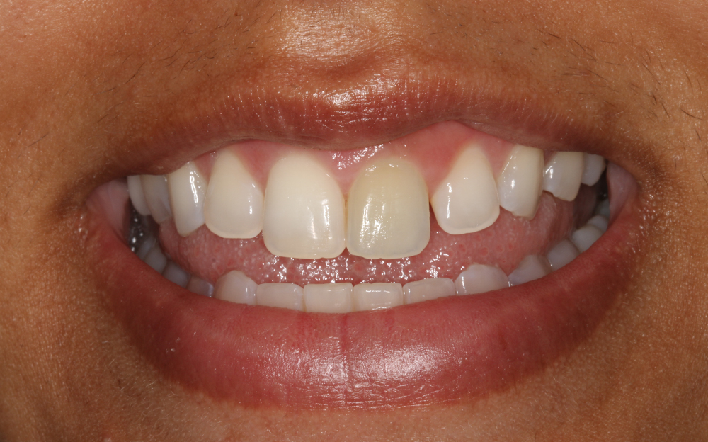 ba-whitening-before ba-whitening-before
