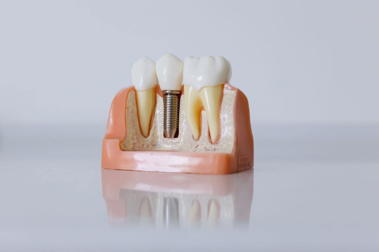 Detailed dental implant model showcasing teeth structure