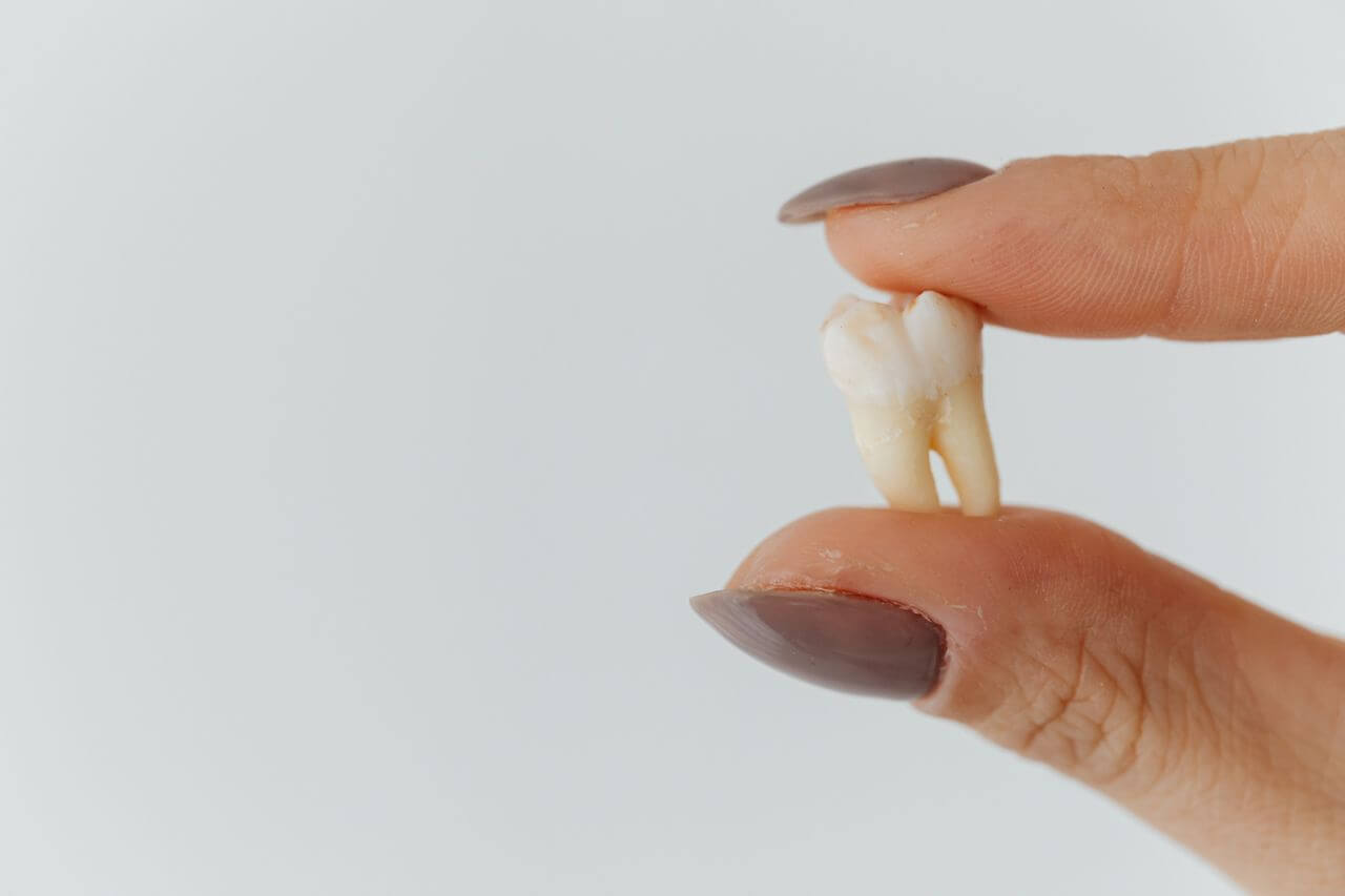 Close up view of a wisdom tooth after wisdom tooth extraction