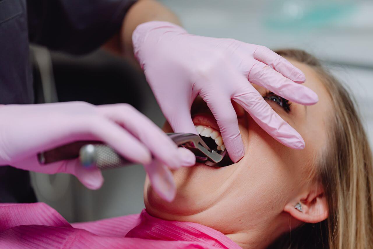 Dental professional using extracting forceps on a patient during a wisdom tooth extraction