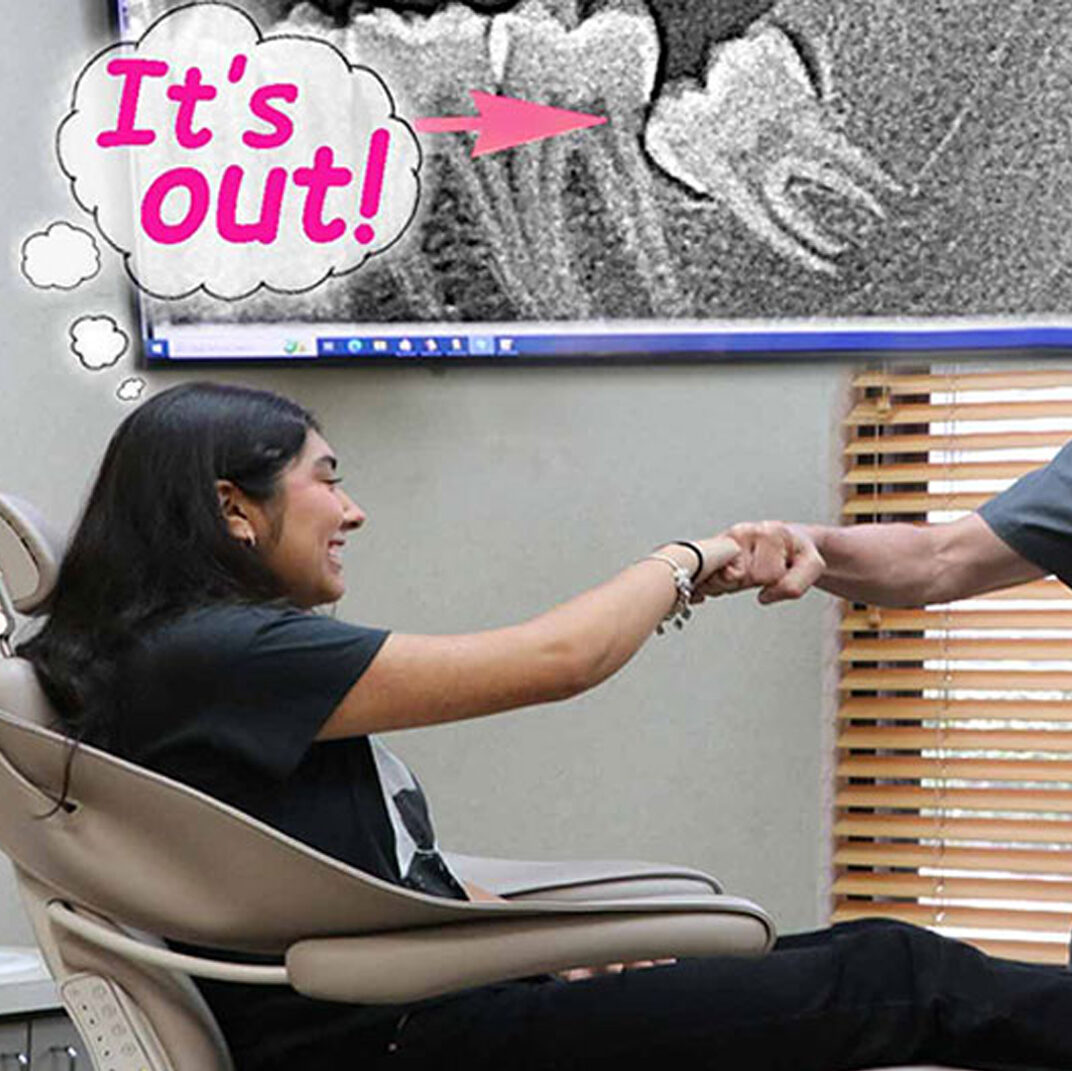 x-ray of wisdom tooth impaction